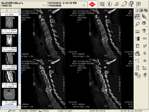These are four of 100's of 'slices' from my CAT Scan of my Cervical Spine; a very extensive nuclear image which is like an x-ray, except much more detailed. Again, like the MRI, one does not have to be a health care professional to see this is one messed up neck. Very visible here is the severe kyphosis (reverse curve); the *worse* the first orthopedic Doctor (who is considered one of the best in the area) said he has ever seen. He refused my case because my neck is so bad. Also visible is one of many bone spurs. This is a very wicked one, hooking over about midway. It is not hard to miss. The degeneration is visible and one of the herniation's is visible (C1/ C2) because that actually herniated so long ago, those two vertebrae fused themselves together. They are at the top and look like a little 'hat' tipping to the side.  