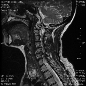 Two herniated disc and advanced stenosis (pressure on the spinal cord; see normal spinal cord at the thoracic level and totally constricted spinal cord at the C spine level). This is separate from my Fibro and causes intense pain, muscle spasms, recurring falls, numb hands and feet among numerous other symptoms.
